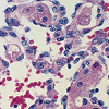 toxicspiderman: A photo of cancer cells, stained for microscope inspection. (hepatic angiocarcinoma)