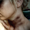 ikissdhimbck: (Bruised)